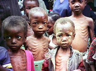 Malnutrition-in-children