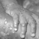 Monkeypox