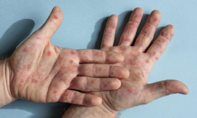 Monkeypox in America