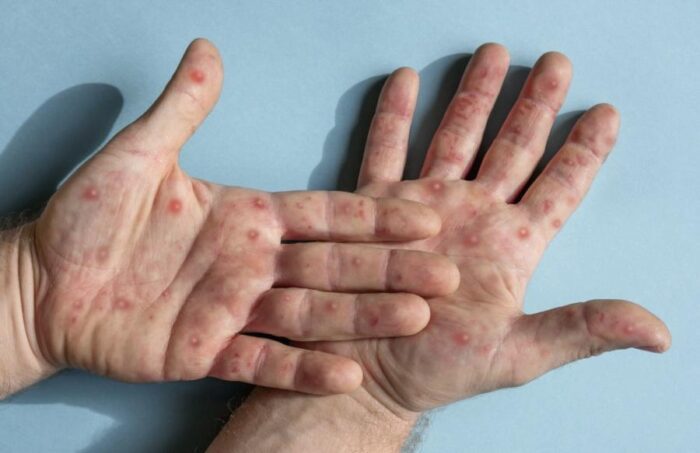 Monkeypox in America