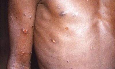 Skinpox