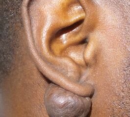 Keloid And Body Piercing