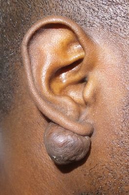 Keloid And Body Piercing