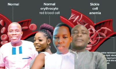 Sickle cell