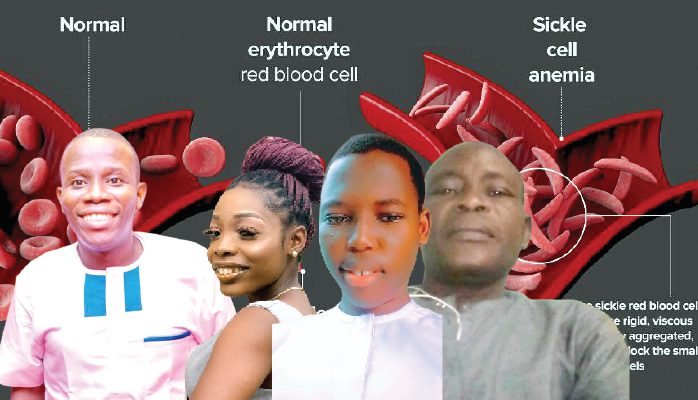 Sickle cell