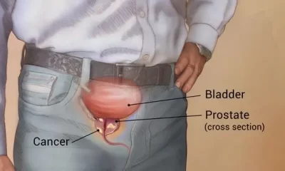 Solution to prostate challenges