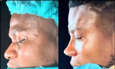Zicsaloma-nose-surgery-2