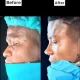 Zicsaloma-nose-surgery-2