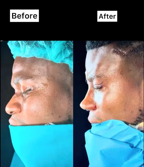 Zicsaloma-nose-surgery-2